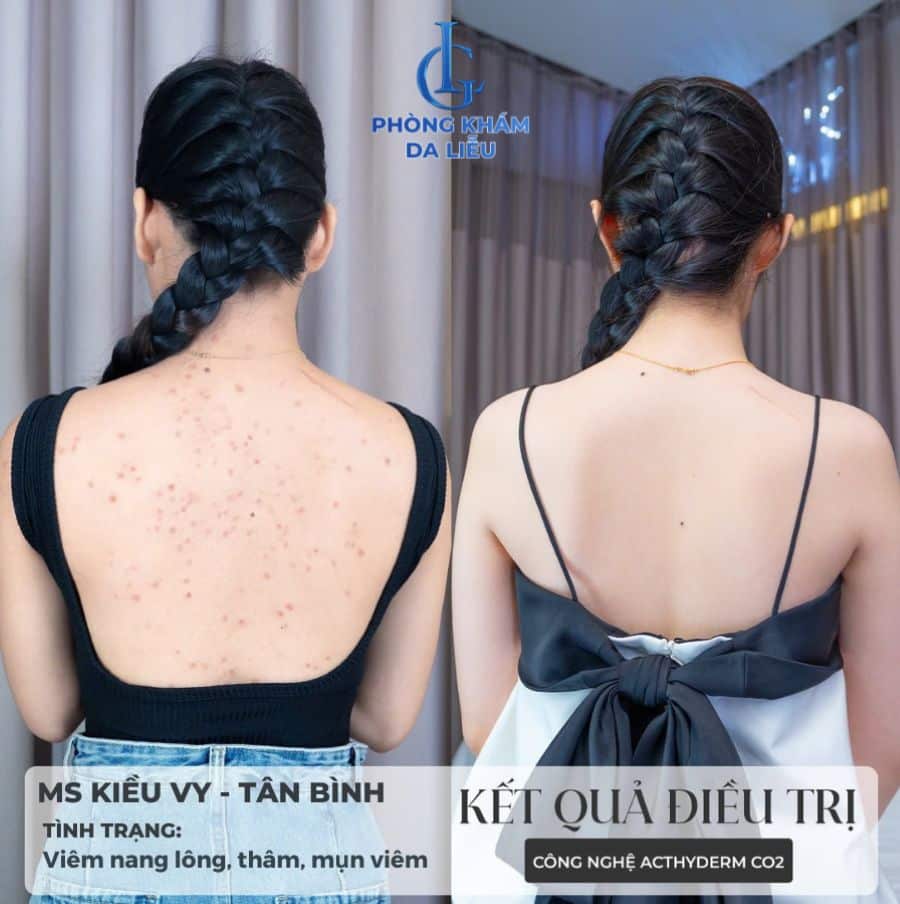 Vùng da lưng sạch mụn, mờ thâm sau khi điều trị tại Phòng khám Da liễu LG